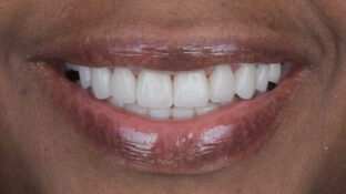 After - Sahil Patel