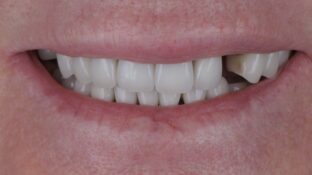 Before - Sahil Patel