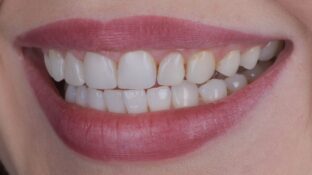 Before - Sahil Patel