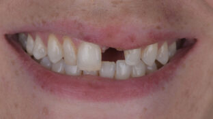 Before - Sahil Patel