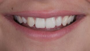 Before - Sahil Patel