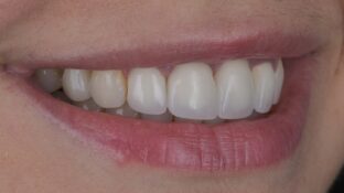 Before - Sahil Patel