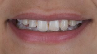 Before - Sahil Patel