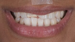 Before - Sahil Patel