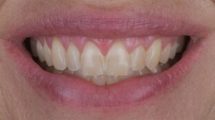 Before - Sahil Patel