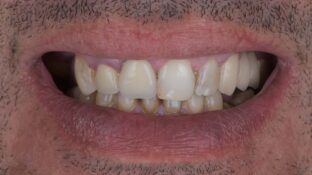 Before - Sahil Patel